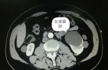 CT 显示左肾囊肿 ？  一个水泡泡儿而已 ！